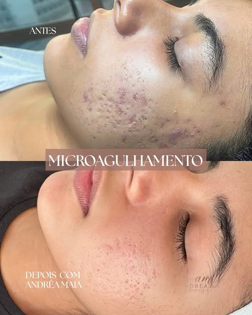 Antes e depois de microagulhamento em cicatrizes de acne.